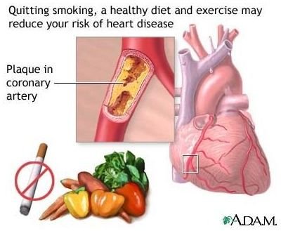 Preventing Heart Disease: Causes, Risk Factors, & Natural Remedies