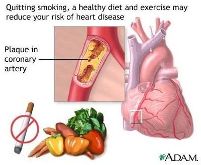 Prevention of Atherosclerosis: Learn the Risks and Steps for Prevention