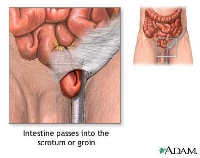 Inguinal Hernia Surgery: Types and Complications