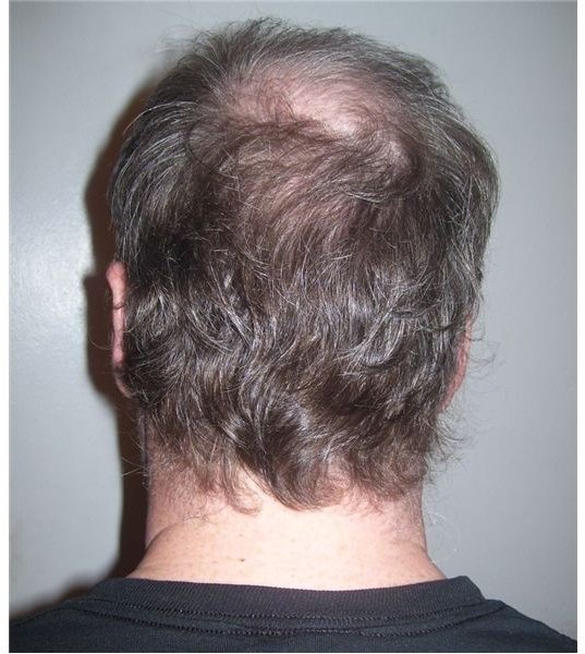 Treatment for Male Pattern Baldness - Getting the Right Kind of Help