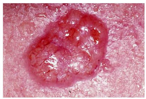 Skin Cancer Warning Signs: Identifying Basal Cell Carcinoma Symptoms