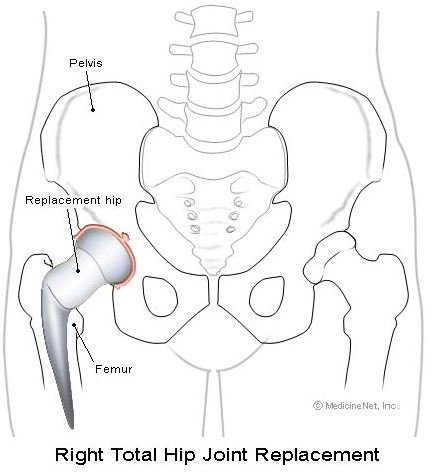 Total Hip Arthroplasty: Exercises for After Your Hip Replacement Surgery