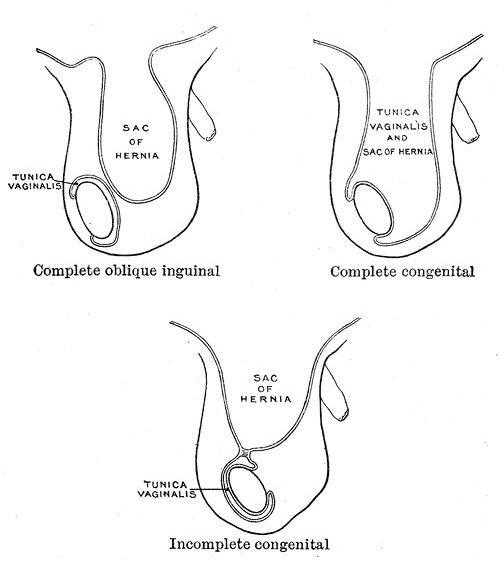 Complications of Inguinal Hernia Surgery