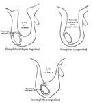 Complications of Inguinal Hernia Surgery