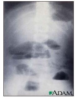 Learn about Small Intestinal Blockage Complication