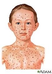 Home Remedies for Chicken Pox in Children
