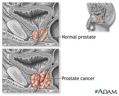 Learn about the Prognosis of Metastatic Prostate Cancer