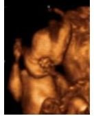 3D ultrasound of 32-week fetus