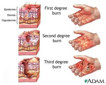 Find Natural Burn Remedies