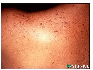 Find Home Remedies for Age Spots