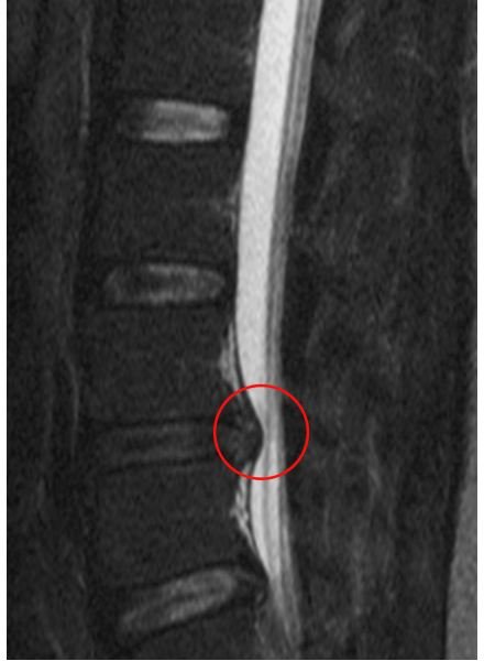 What are the Possible Complications of Degenerative Disc Disease?