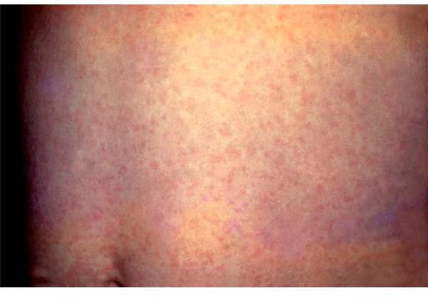 The rubella rash is very similar to the regular measles rash. It is less intense and not as red.