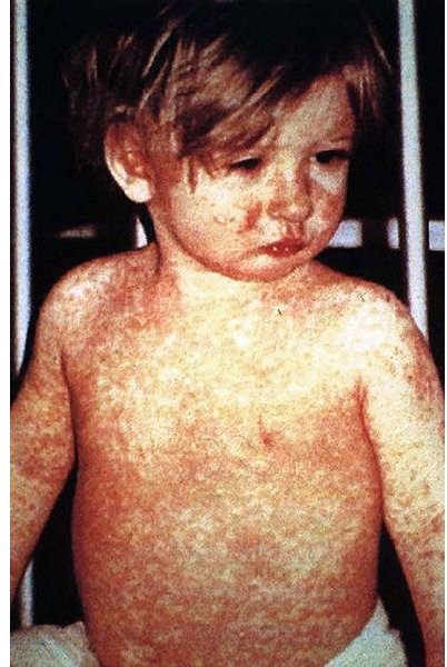 Treatment for Measles in Children