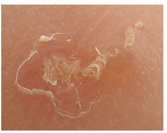 Find Home Remedies for Scabies in Humans