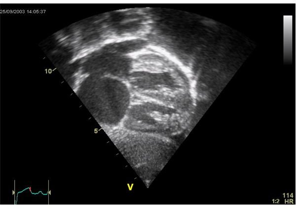 Echocardiogram: Purpose, Preparation, and What to Expect During an Echocardiogram