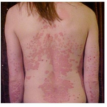 Understanding the Genetics of Psoriasis: A Look at What Causes Psoriasis