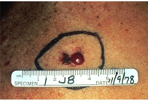 How Fast Does Melanoma Spread?
