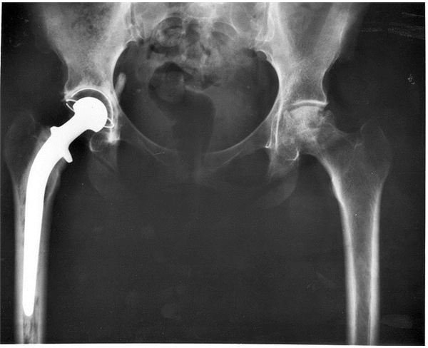 An A-P X-ray of a pelvis showing a total hip joint replacement due to osteoarthritis