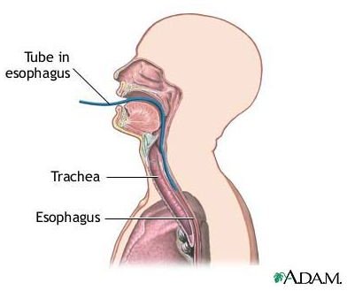 Is Laparoscopic Surgery for Esophageal Cancer an Option for You?