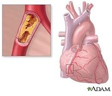 The Symptoms of Arterial Blockage in the Heart