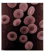 Hereditary Spherocytosis, Hemolytic Anemia and Abnormal Red Blood Cells