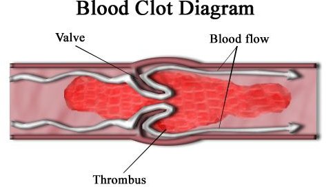 What Does Phlebitis Look Like?