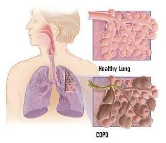 COPD: The Final Stages