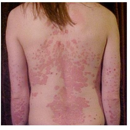 Treating Psoriasis with Essential Oils: A Natural Way to Help Treat and Prevent Outbreaks