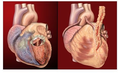 Angina After Valve Repair: A Review of the Causes and Treatment Options