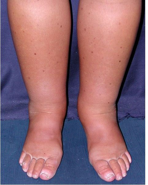 What Are the Possible Complications of Lymphedema?