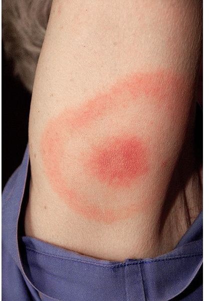 bullseye-rash-for-lyme-disease-health-guide-info