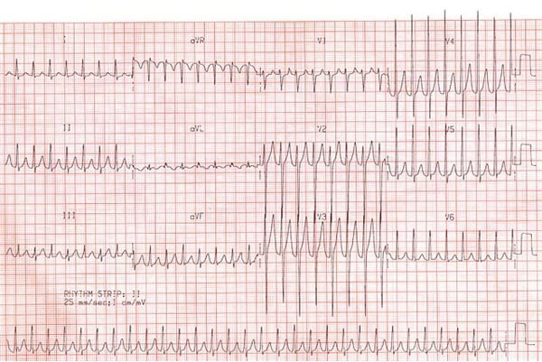 Tachycardia