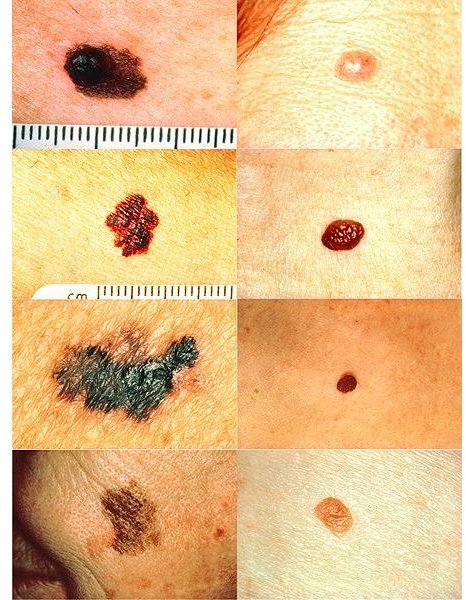 Identify Melanoma Moles and Skin Cancer