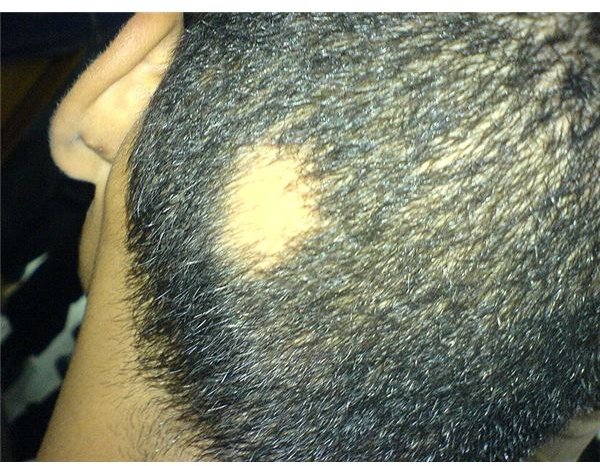 What is Alopecia Areata and How are Genes Involved in Alopecia Areata Causes
