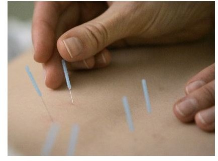 Acupuncture – The Prickly Treatment with Excellent Results