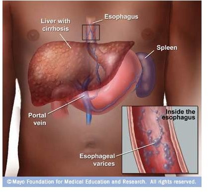 What You Need to Know About Bleeding Esophogeal Varices