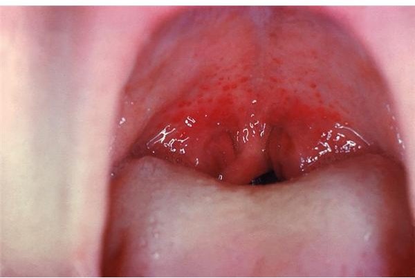 Recurrent, Chronic Strep Throat: Symptoms, Diagnosis & Treatment of Chronic or Recurrent Strep Throat