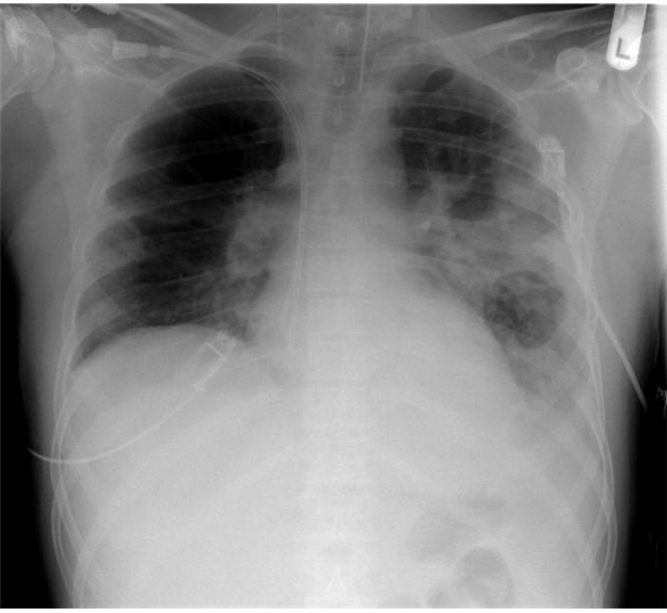 Learn About the Different Types of Pneumonia and How They Are Classified