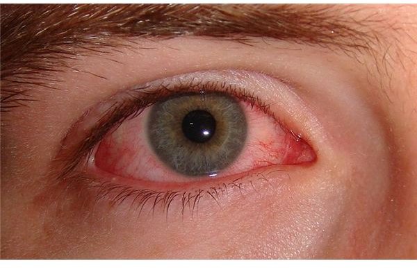 Home Remedies For Pink Eye:  Learn About Natural Cures for Conjunctivitis