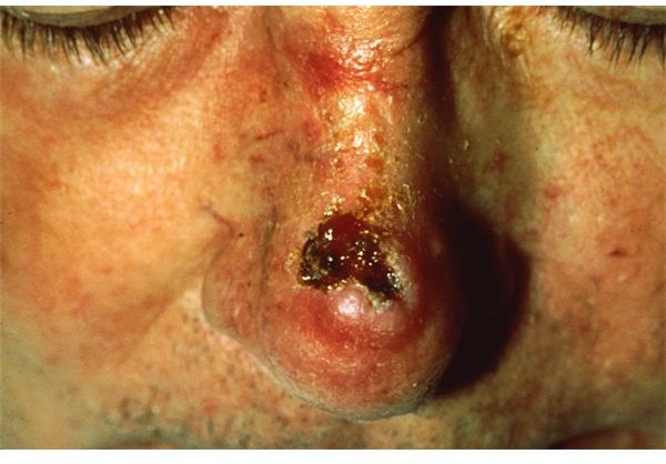 Squamous Cell Carcinoma Appearance