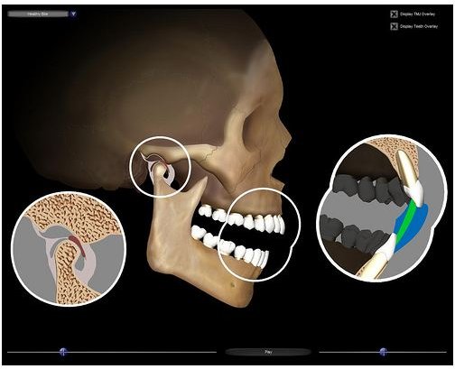 Learn How to Treat TMJ (Temporomandibular Joint Disorder)