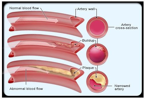 What Are Statins and Can They Reduce the Risk of Cardiac Events?