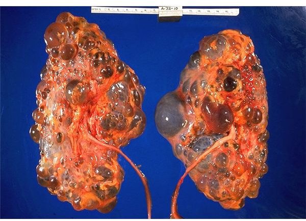 Polycystic Kidney Disease - The Genes That Cause  Autosomal Recessive and Autsomal Dominant Polycystic Kidney Disease