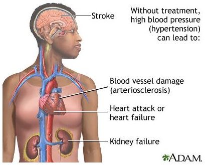 The Essential Hypertension Definition, Treatment, and Prevention