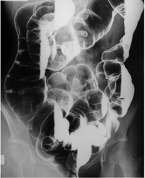 Intestinal polyposis (Peutz-Jegher syndrome) Barium Enema