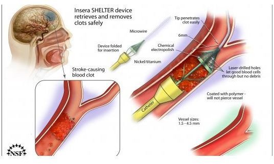 Aortic Atherosclerosis: Risk Factors, Symptoms and Treatment