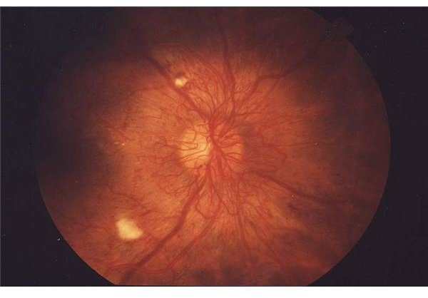 Proliferative retinopathy