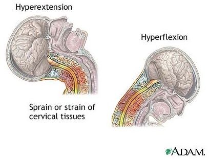 What is Whiplash? Find Information about Whiplash