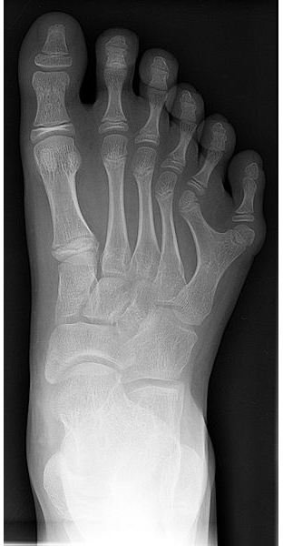 How is Polydactyly Inherited wikimedia commons drgnu23 foot