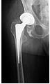 Total Hip Replacement Surgery: Purpose, Procedure, Recovery, and Possible Risks and Complications